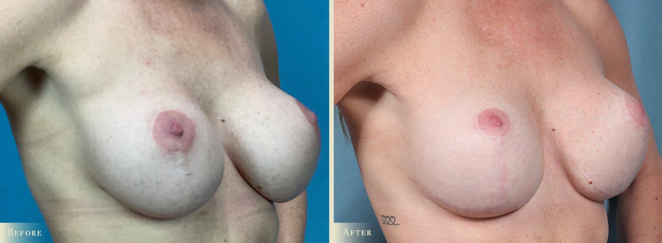 Breast Implant Revision/Replacement Before & After Gallery - Patient 639488 - Image 2