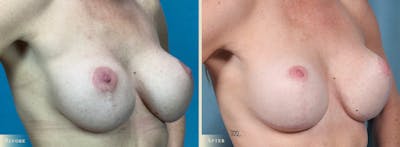 Breast Implant Revision/Replacement Before & After Gallery - Patient 639488 - Image 2