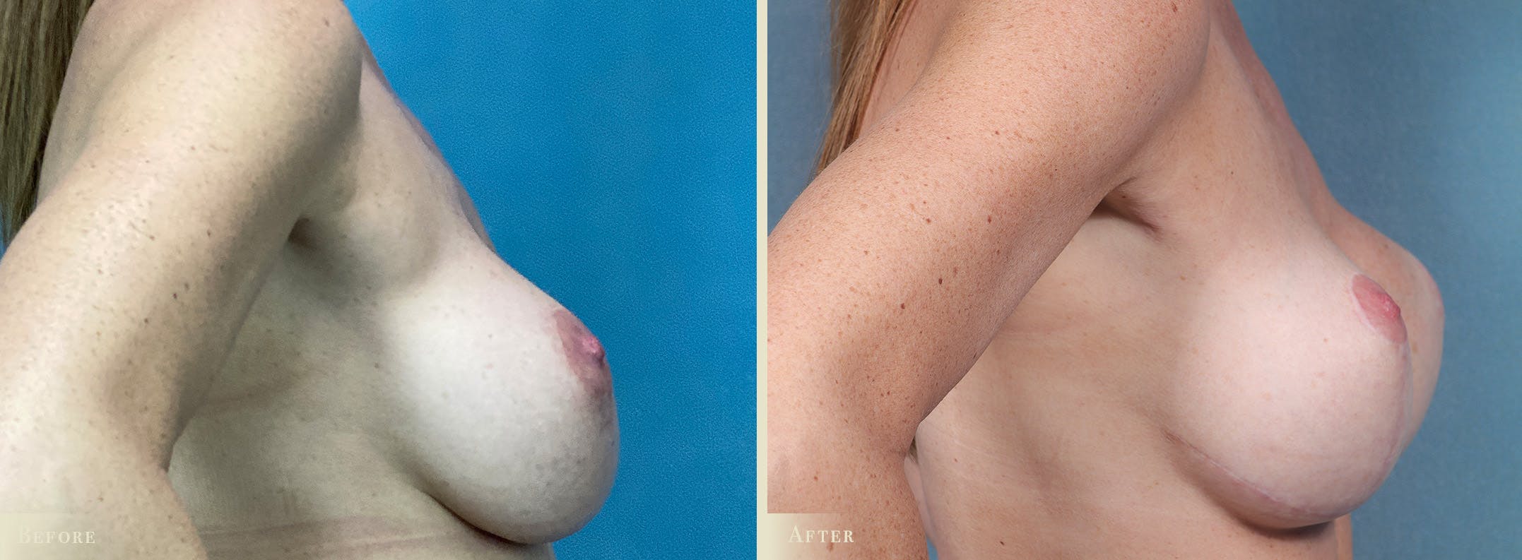 Breast Implant Revision/Replacement Before & After Gallery - Patient 639488 - Image 3