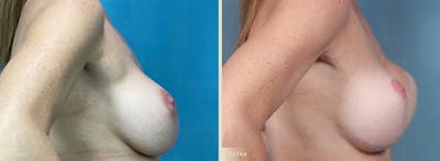 Breast Implant Revision/Replacement Before & After Gallery - Patient 639488 - Image 3