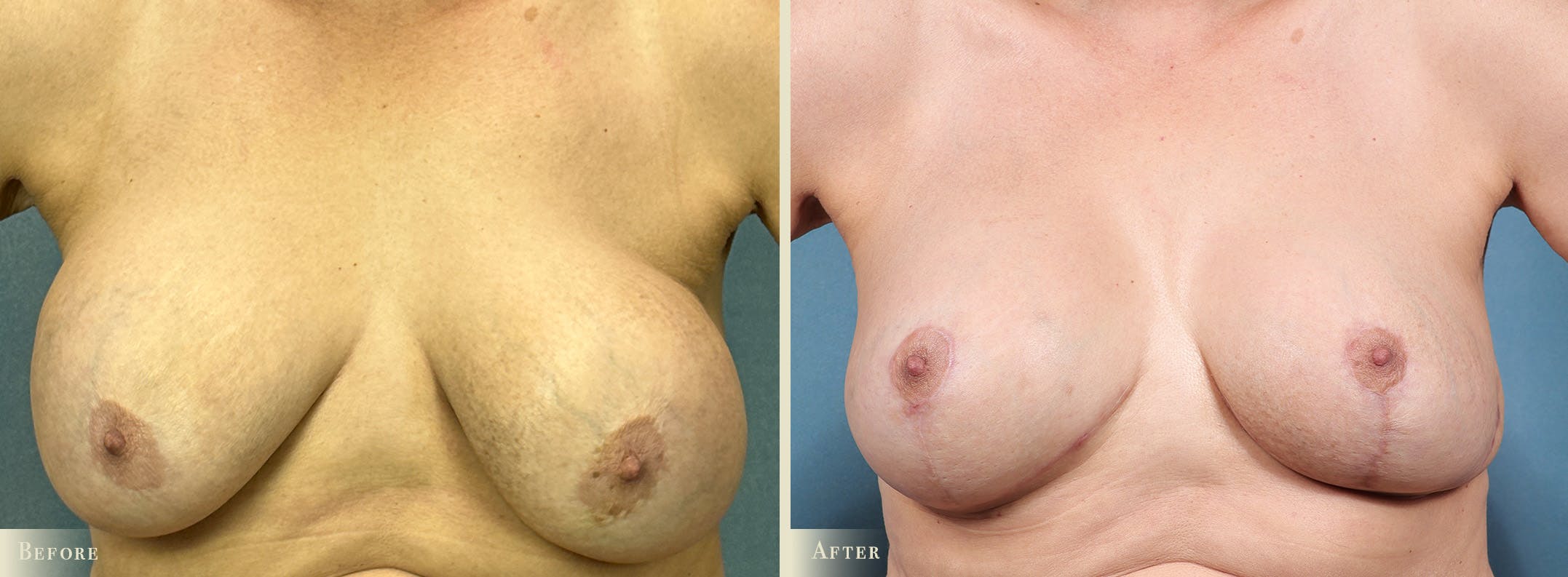 Breast Implant Revision/Replacement Before & After Gallery - Patient 131484 - Image 1