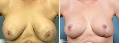 Breast Implant Revision/Replacement Before & After Gallery - Patient 131484 - Image 1