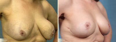 Breast Implant Revision/Replacement Before & After Gallery - Patient 131484 - Image 2