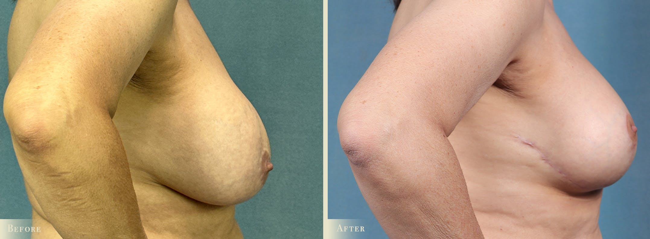 Breast Implant Revision/Replacement Before & After Gallery - Patient 131484 - Image 3