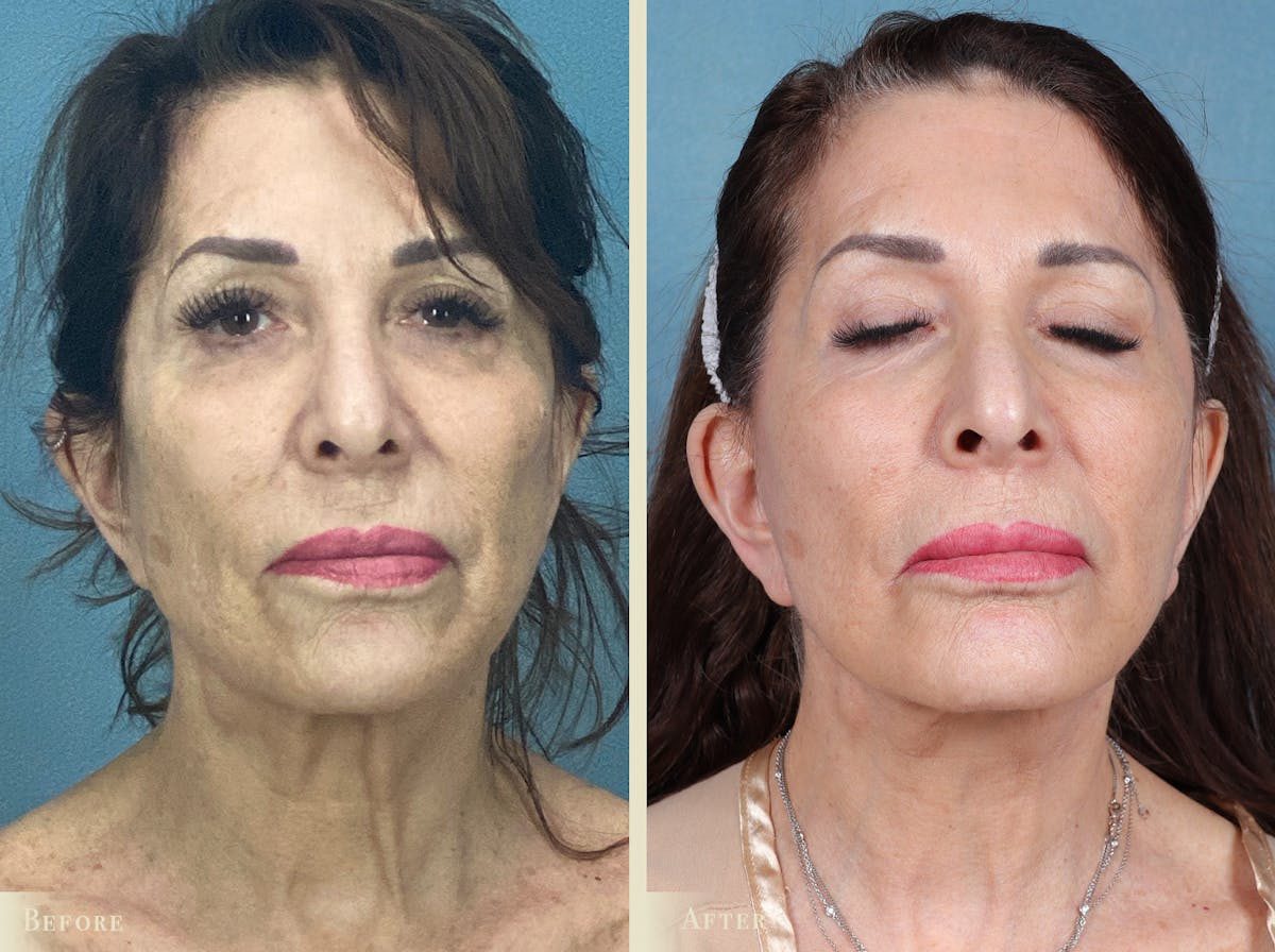 Facelift Before & After Gallery - Patient 886317 - Image 1