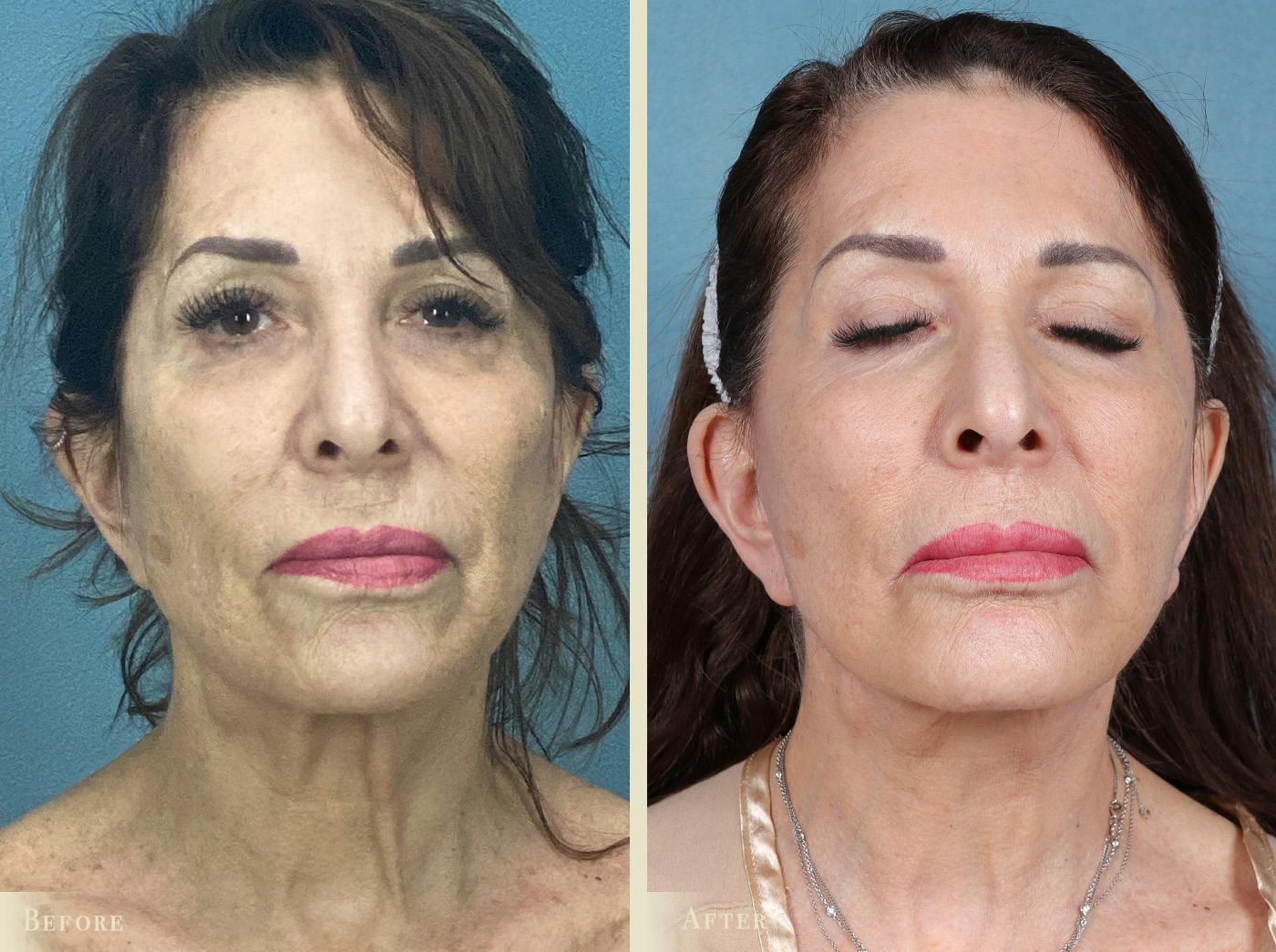 CO2 Laser Resurfacing Before & After Gallery - Patient 394274 - Image 1