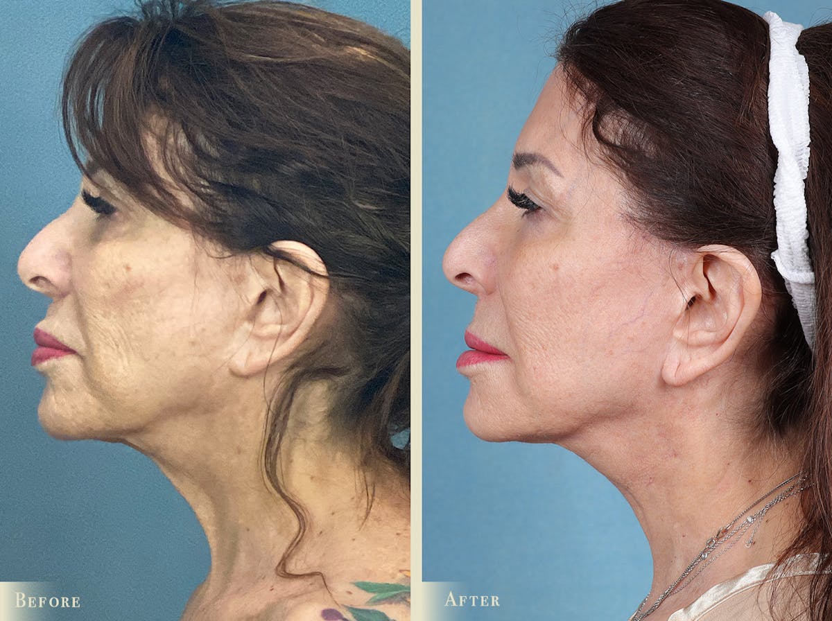 Facelift Before & After Gallery - Patient 886317 - Image 2
