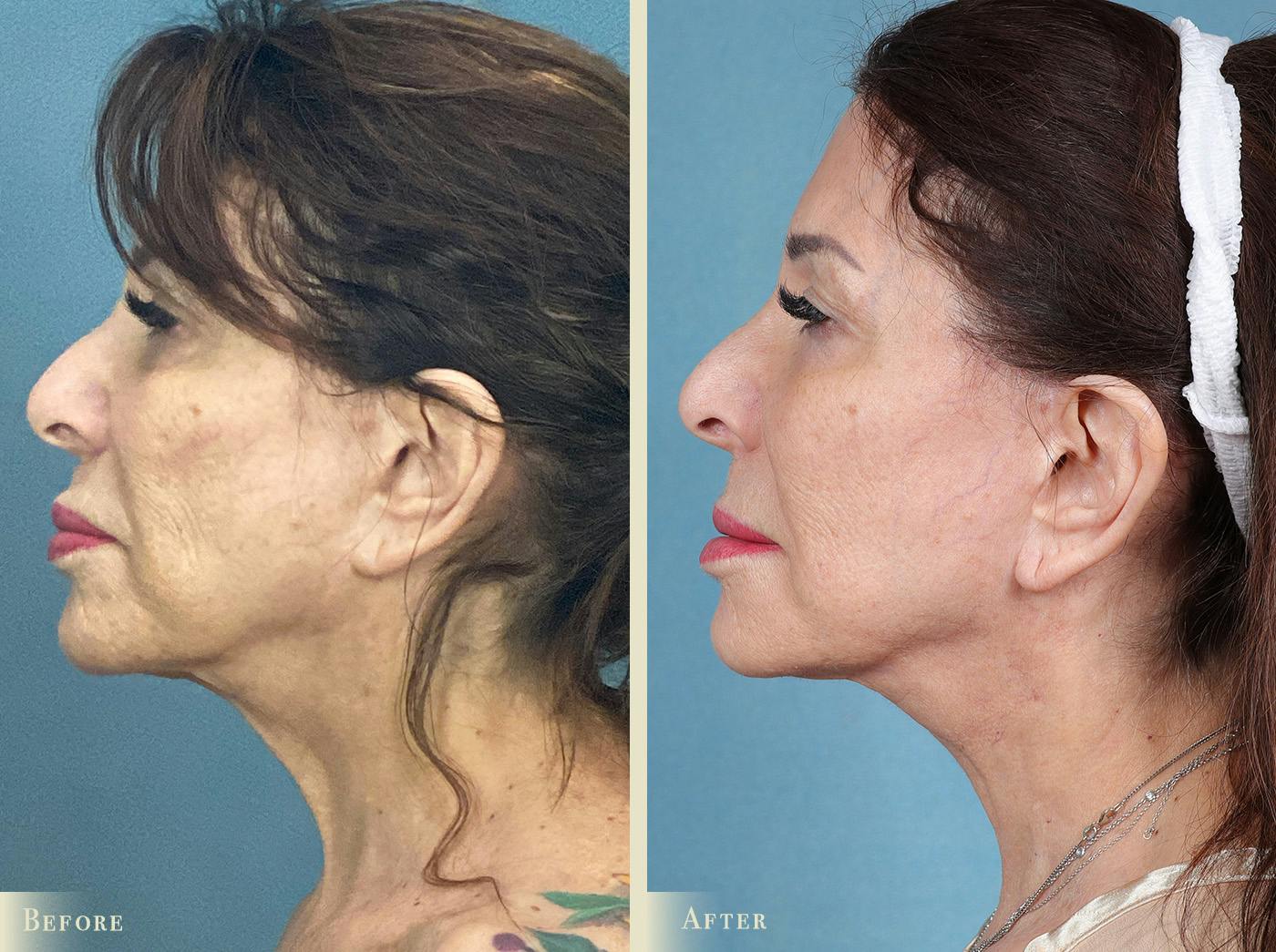 CO2 Laser Resurfacing Before & After Gallery - Patient 394274 - Image 2