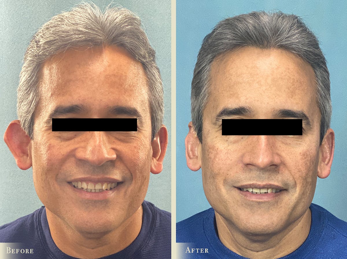 Ear Surgery Before & After Gallery - Patient 403729 - Image 1