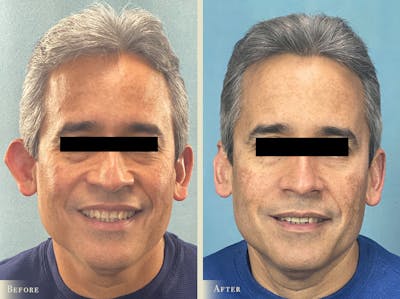 Ear Surgery Before & After Gallery - Patient 403729 - Image 1
