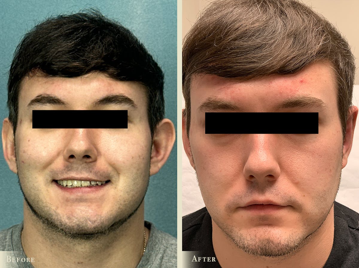 Otoplasty Before & After Gallery - Patient 345782 - Image 1