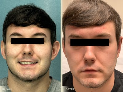 Ear Surgery Before & After Gallery - Patient 251594 - Image 1