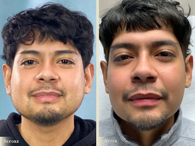 Buccal Fat Removal Before & After Gallery - Patient 181939 - Image 1