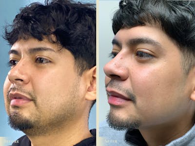 Buccal Fat Removal Before & After Gallery - Patient 181939 - Image 2