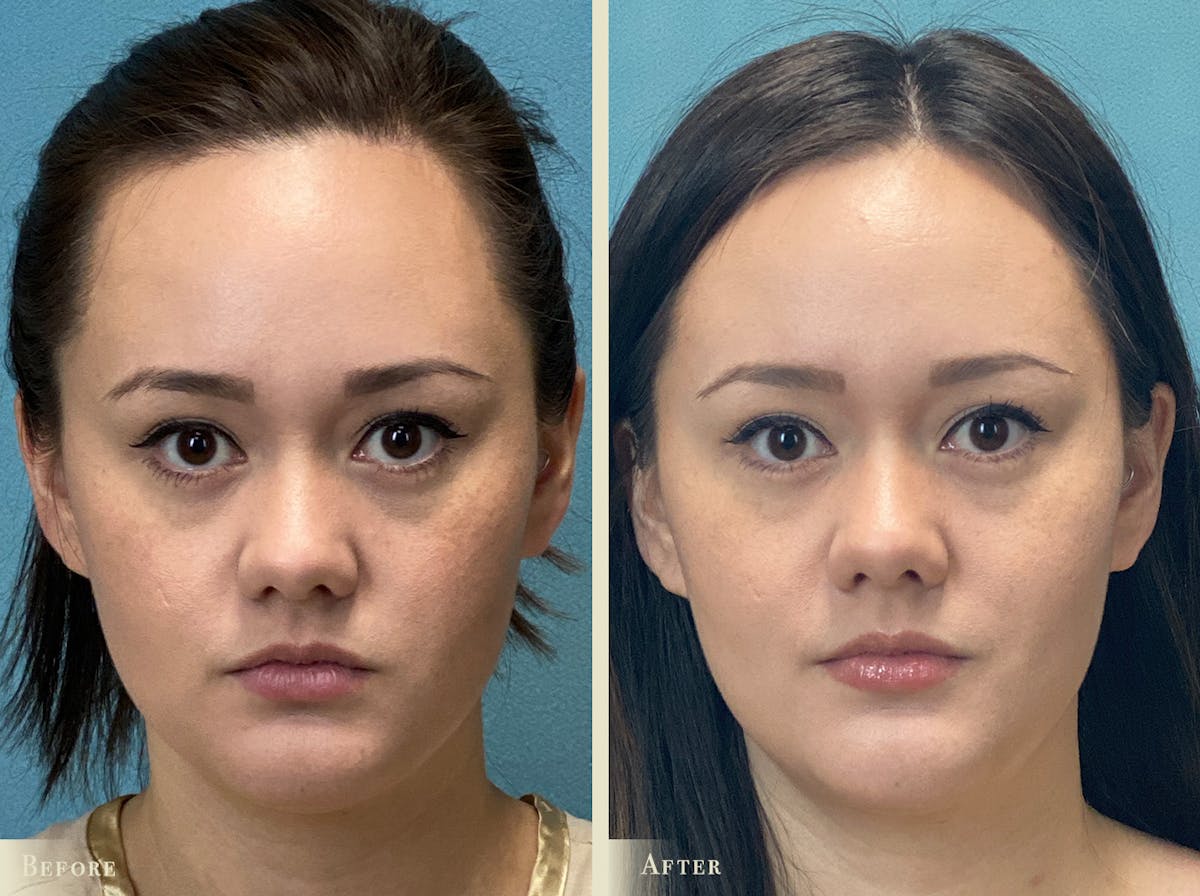 Buccal Fat Removal Before & After Gallery - Patient 255182 - Image 1