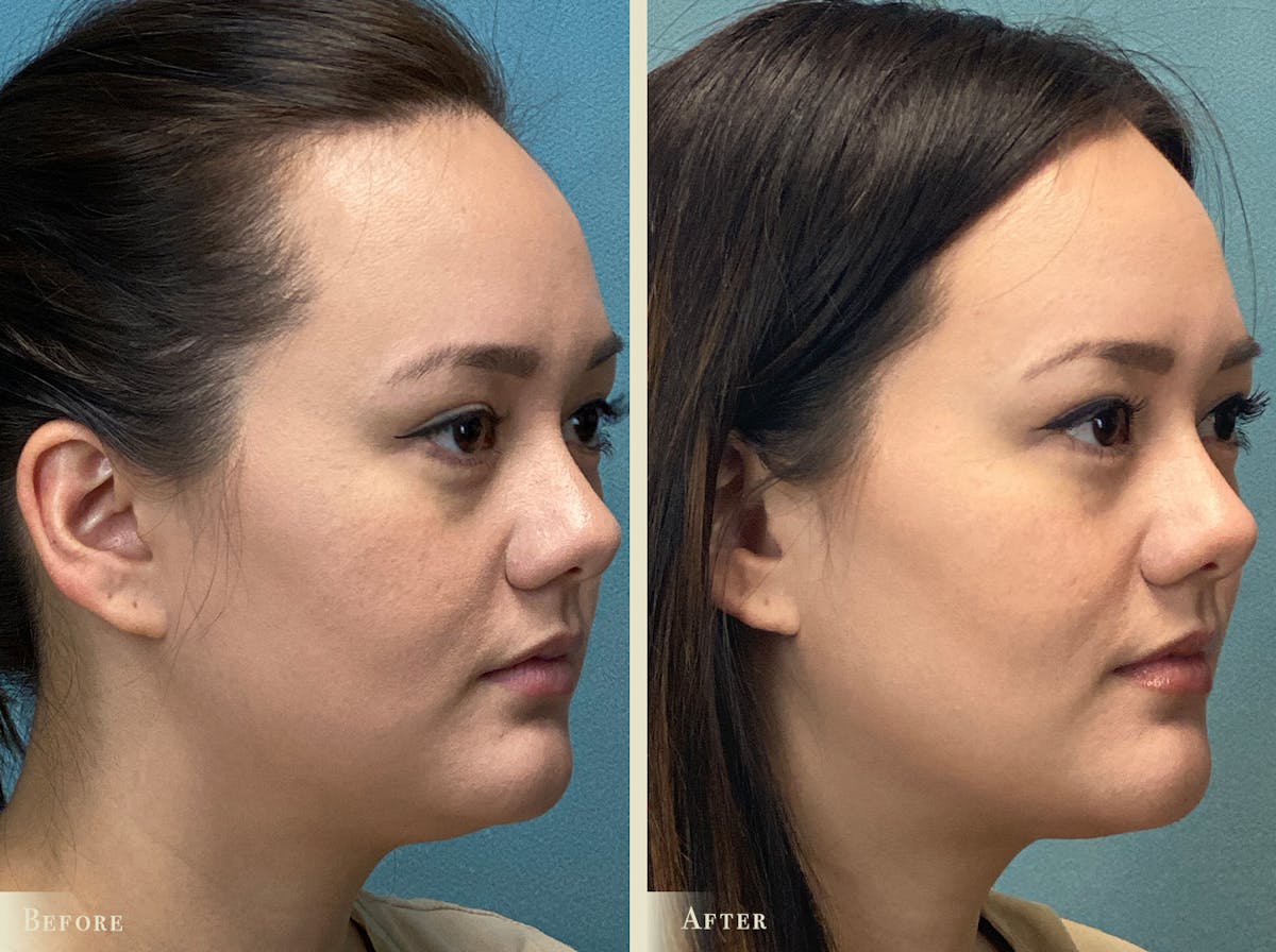 Buccal Fat Removal Before & After Gallery - Patient 255182 - Image 2