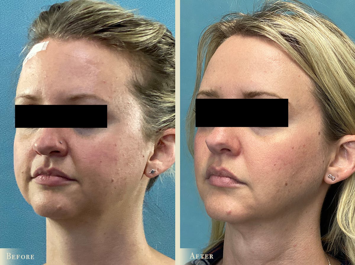 Buccal Fat Removal Before & After Gallery - Patient 276585 - Image 2