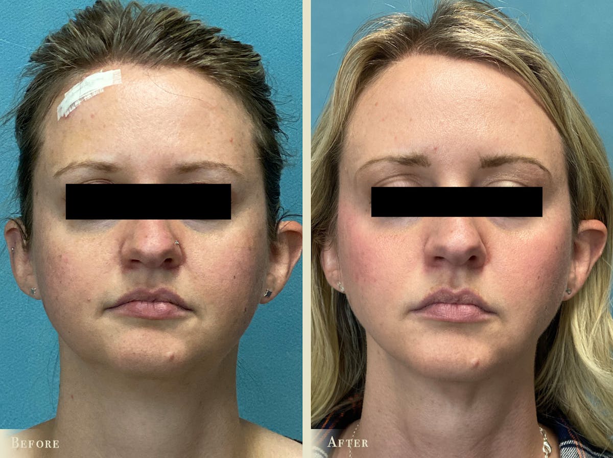 Buccal Fat Removal Before & After Gallery - Patient 276585 - Image 1