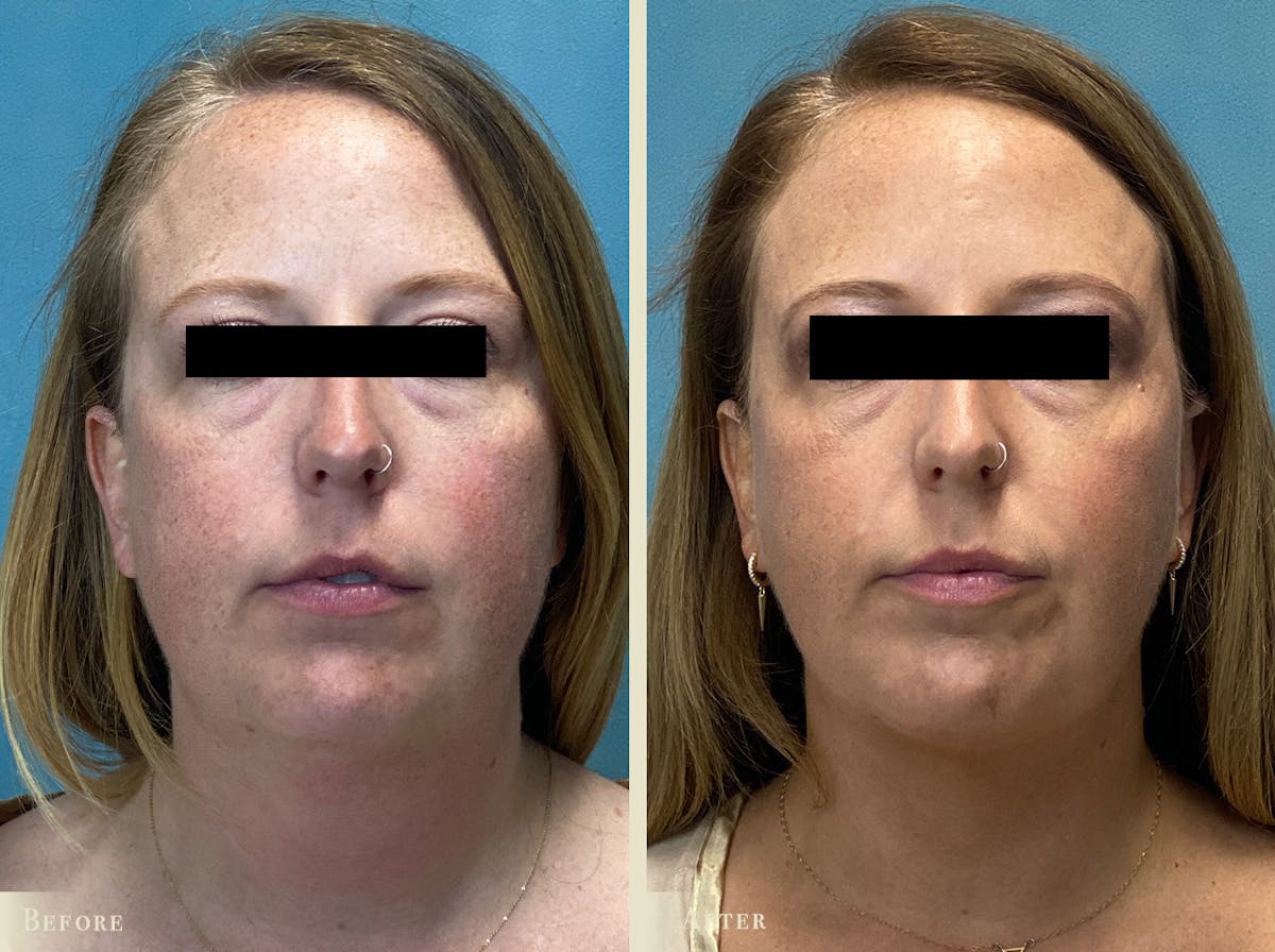 Neck Liposuction Before & After Gallery - Patient 195280 - Image 1