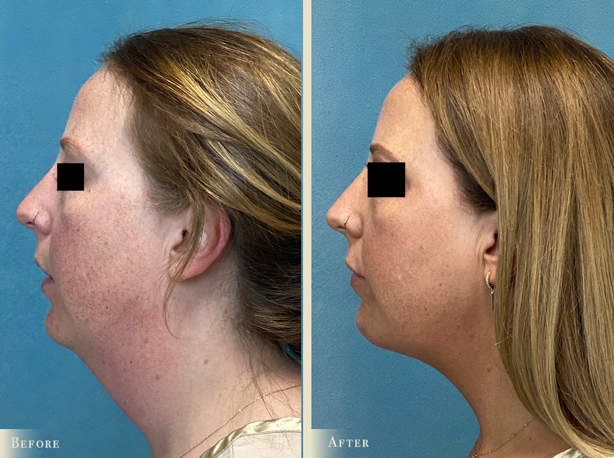 Neck Liposuction Before & After Gallery - Patient 195280 - Image 2