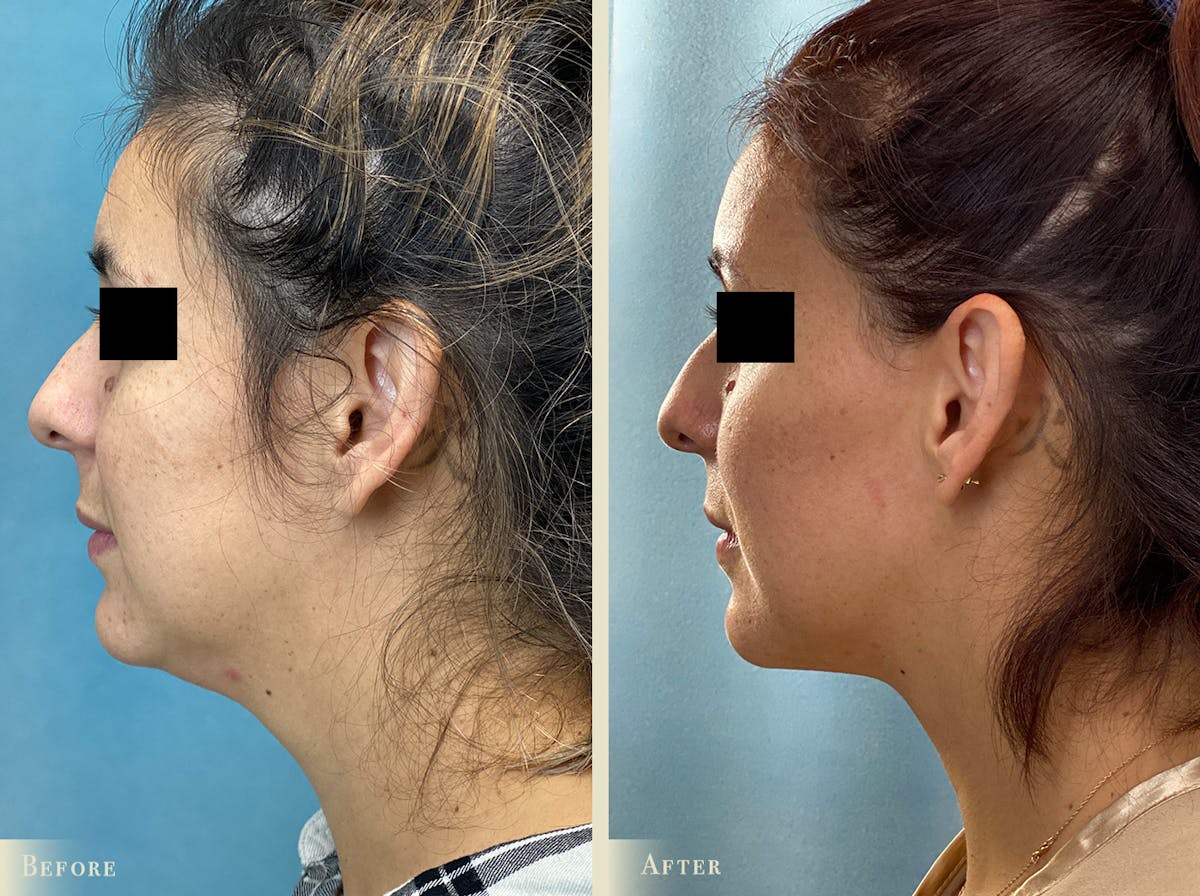 Neck Liposuction Before & After Gallery - Patient 177268 - Image 2