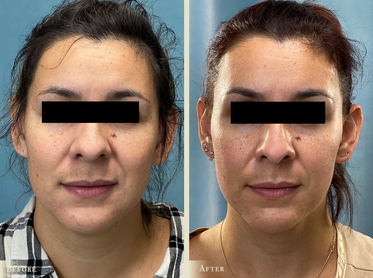 Neck Liposuction Before & After Gallery - Patient 177268 - Image 1