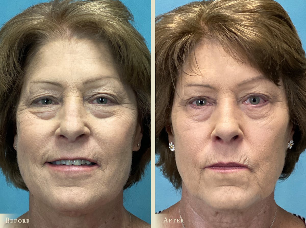 Eyelid Lift Before & After Gallery - Patient 696682 - Image 1
