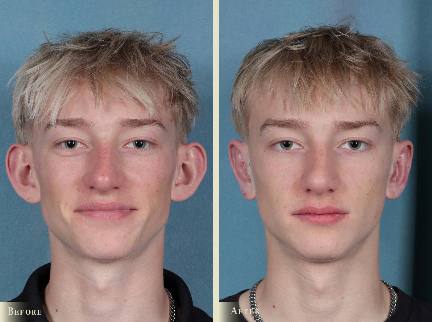 Ear Surgery Before & After Gallery - Patient 157228 - Image 1