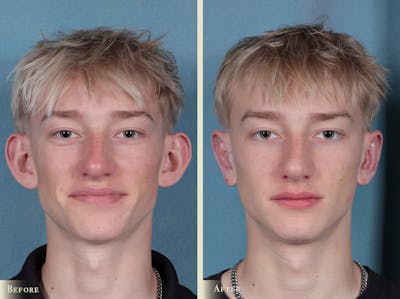 Ear Surgery Before & After Gallery - Patient 157228 - Image 1
