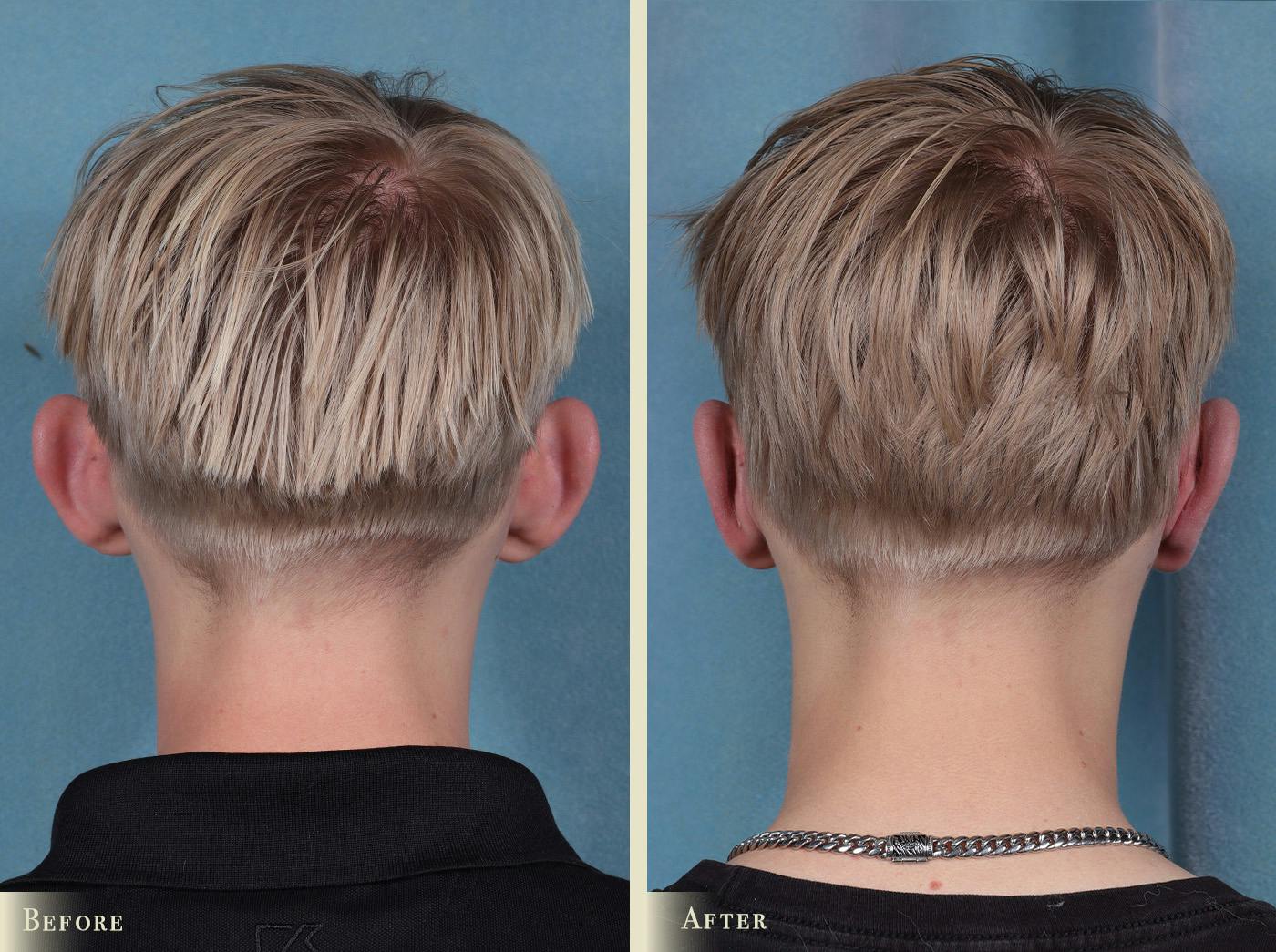 Ear Surgery Before & After Gallery - Patient 157228 - Image 2
