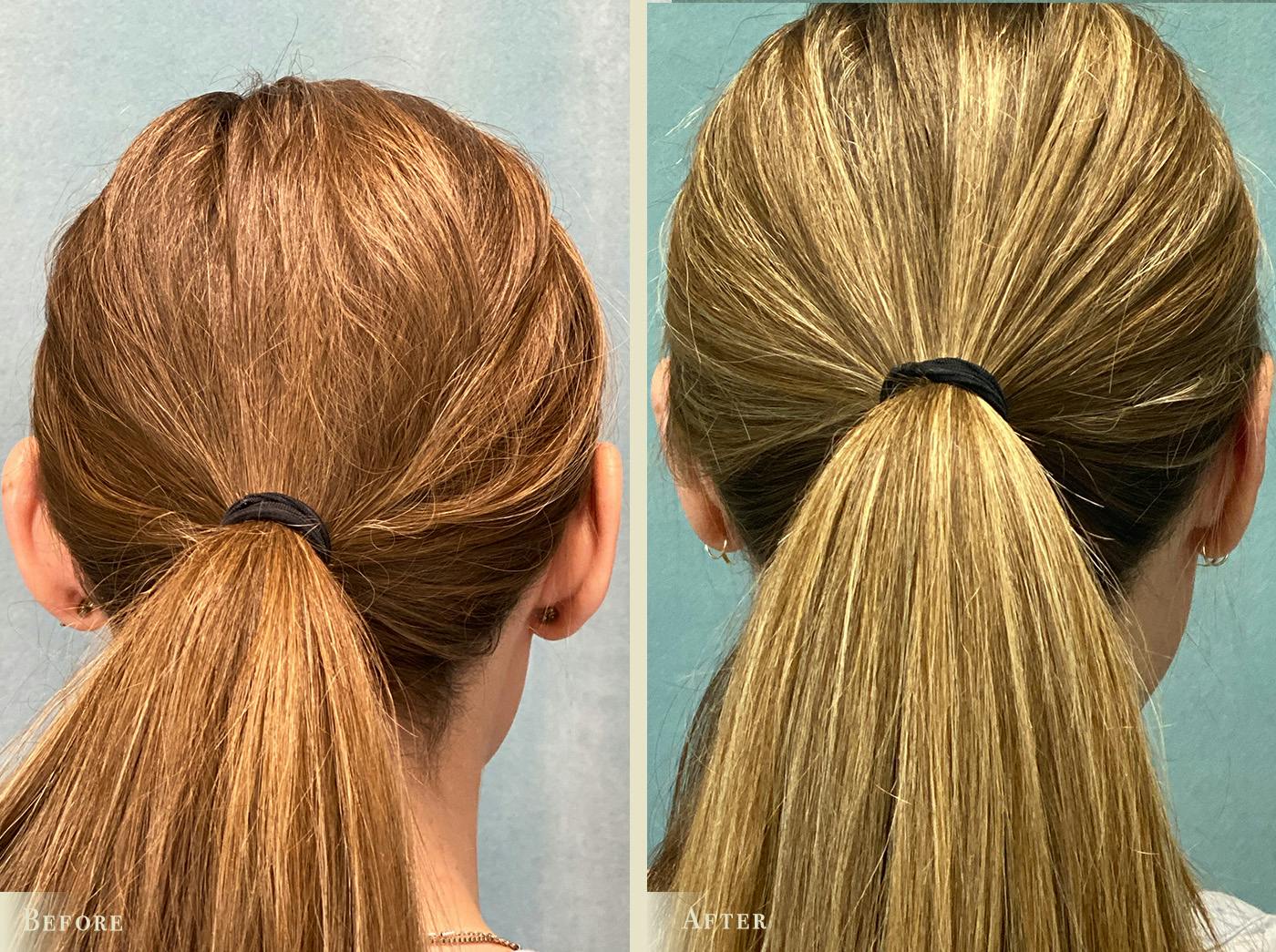 Ear Surgery Before & After Gallery - Patient 303035 - Image 2