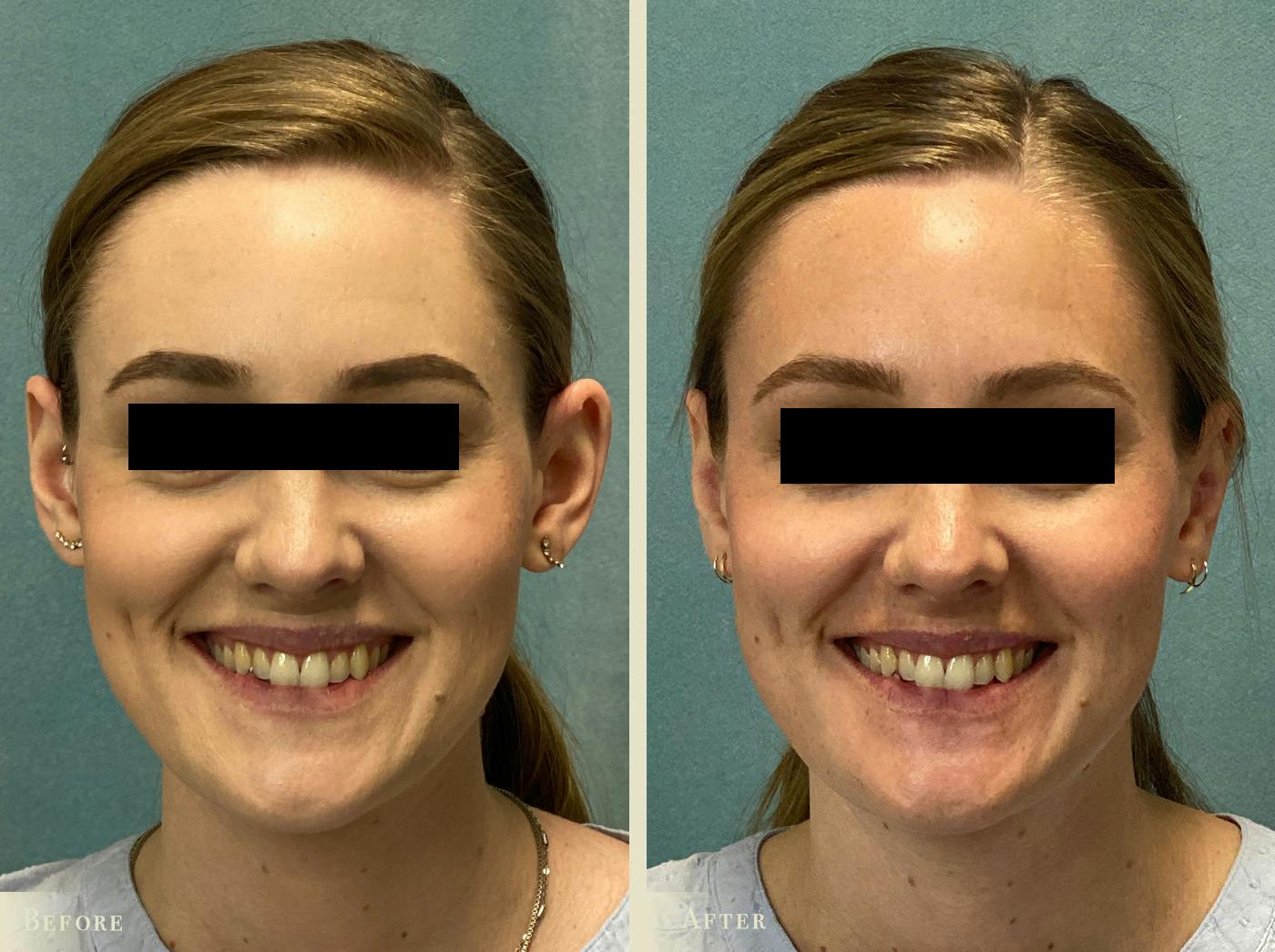 Ear Surgery Before & After Gallery - Patient 303035 - Image 1