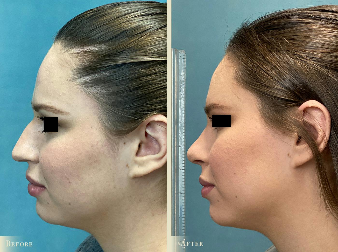 Aesthetic Rhinoplasty Before & After Gallery - Patient 889154 - Image 1