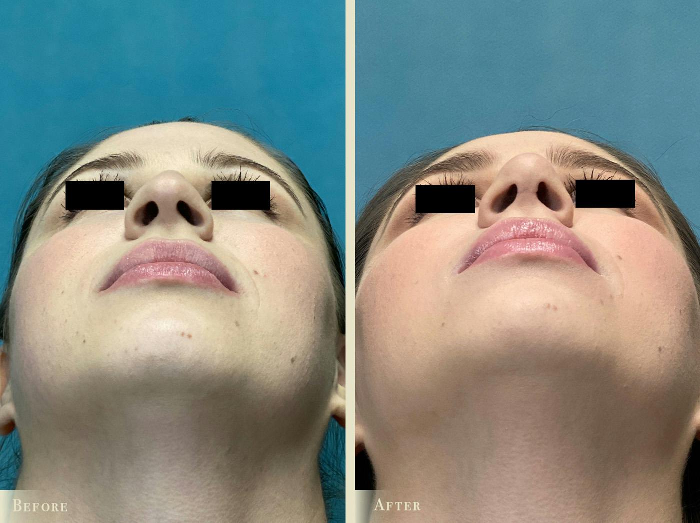 Aesthetic Rhinoplasty Before & After Gallery - Patient 889154 - Image 3