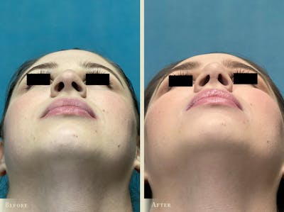 Aesthetic Rhinoplasty Before & After Gallery - Patient 889154 - Image 3