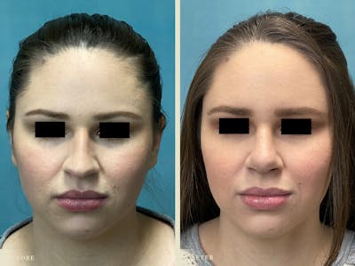Aesthetic Rhinoplasty Before & After Gallery - Patient 889154 - Image 2