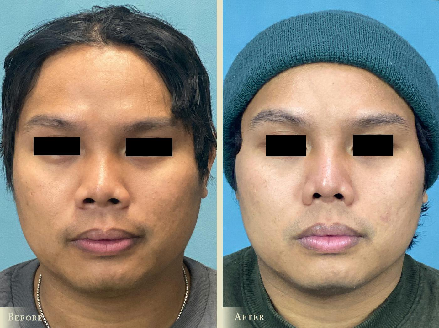 Aesthetic Rhinoplasty Before & After Gallery - Patient 403280 - Image 3