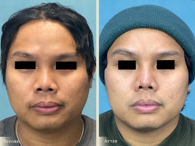 Aesthetic Rhinoplasty Before & After Gallery - Patient 403280 - Image 3