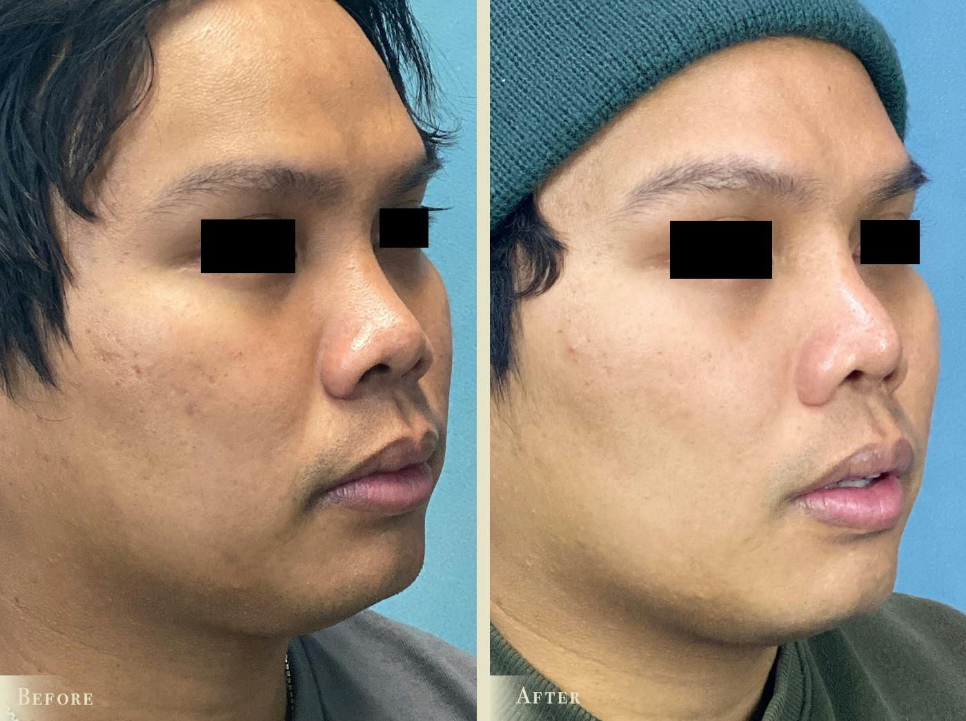 Aesthetic Rhinoplasty Before & After Gallery - Patient 403280 - Image 2