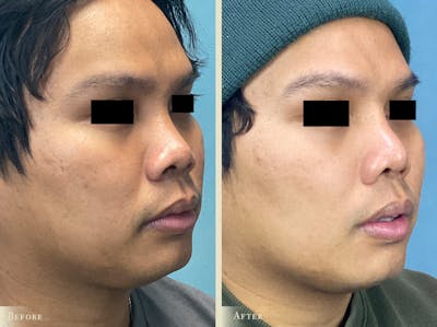 Aesthetic Rhinoplasty Before & After Gallery - Patient 403280 - Image 2