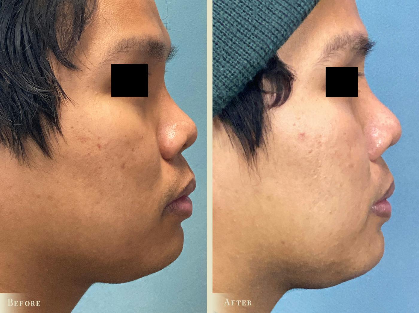 Aesthetic Rhinoplasty Before & After Gallery - Patient 403280 - Image 1