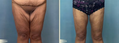 Thigh Lift Before & After Gallery - Patient 201805 - Image 1