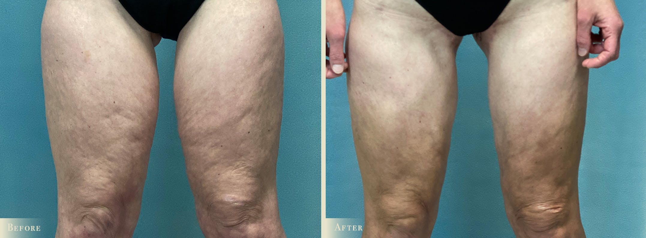 Thigh Lift Before & After Gallery - Patient 210221 - Image 1