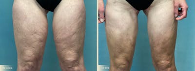 Thigh Lift Before & After Gallery - Patient 210221 - Image 1