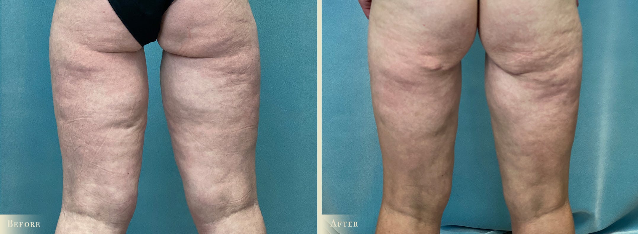 Thigh Lift Before & After Gallery - Patient 210221 - Image 2