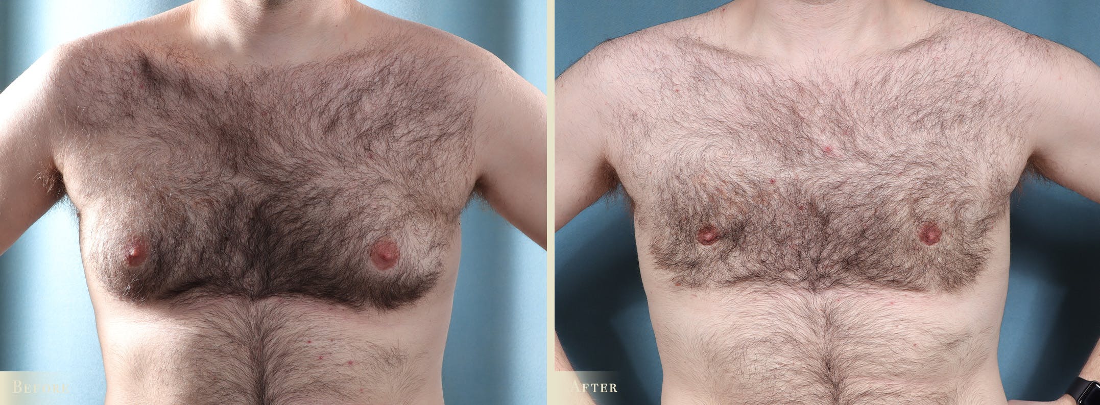 Male Breast Reduction (Gynecomastia) Before & After Gallery - Patient 237212 - Image 1