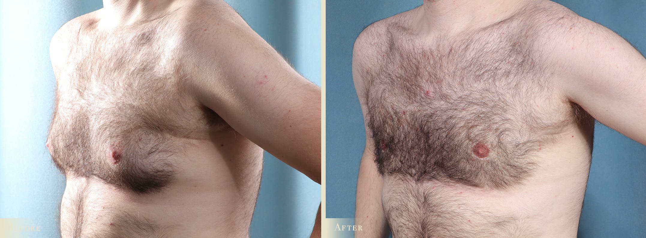 Male Breast Reduction (Gynecomastia) Before & After Gallery - Patient 237212 - Image 2