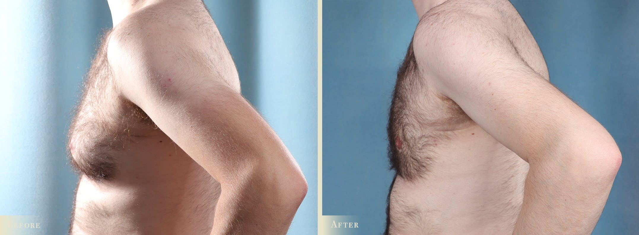 Male Breast Reduction (Gynecomastia) Before & After Gallery - Patient 237212 - Image 3