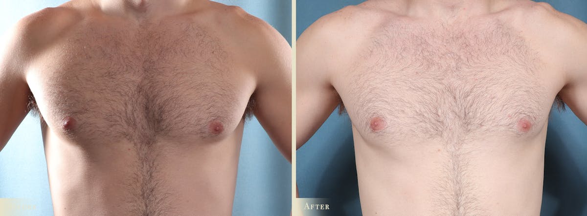 Male Breast Reduction (Gynecomastia) Before & After Gallery - Patient 200969 - Image 1