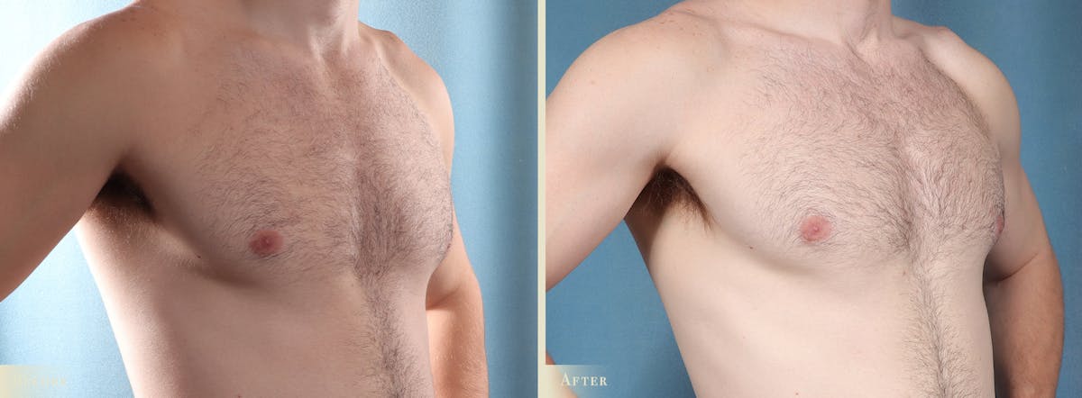 Male Breast Reduction (Gynecomastia) Before & After Gallery - Patient 200969 - Image 2